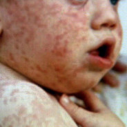 Measles And Fear